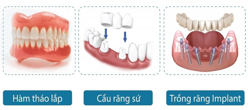 Trồng răng Implant có chi phí cao hơn so với phương pháp phục hình trước đây