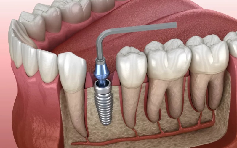 Giá trồng răng Implant còn phụ thuộc vào rất nhiều yếu tố
