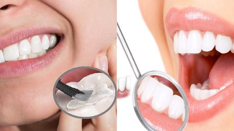 Bọc răng sứ hay trám răng là tùy thuộc vào từng tình trạng của răng