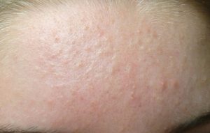                               Mụn ẩn dưới da thường xuất hiện ở trán