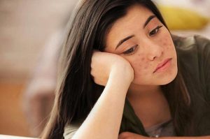                               Mụn đỏ 2 bên má khiến bạn cảm thấy chán nản