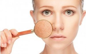 Biểu hiện của sẹo lõm trên da