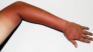 Da bị cháy nắng do tiếp xúc nhiều giờ với tia tử ngoại