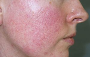 Da mặt mỏng nổi mạch máu rất dễ dị ứng, tổn thương