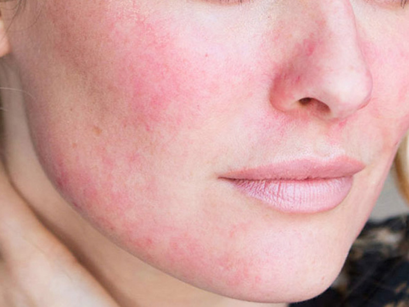 Tại sao da mặt đỏ và mỏng