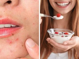 Ăn sữa chua có hiệu quả trị mụn, dưỡng da