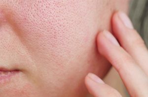 Cạo lông mặt giúp thu nhỏ lỗ chân lông