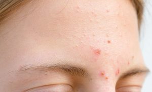 Mụn ở trán xuất hiện bởi ảnh hưởng từ hormone gây nên