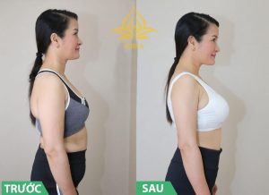 Hiệu quả giảm béo cao tại Viện thẩm mỹ Quốc tế Korea Phan Rang