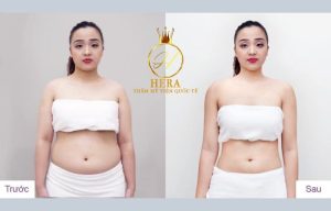 Hiệu quả giảm béo vượt trội tại Viện thẩm mỹ quốc tế Hera