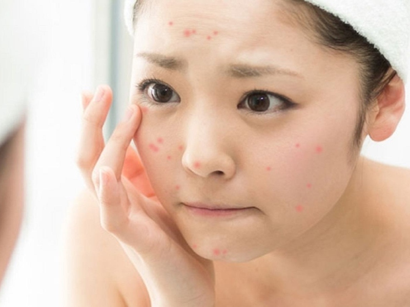Sản phẩm nhái, kém chất lượng là nguyên nhân hàng đầu khiến da nổi mụn