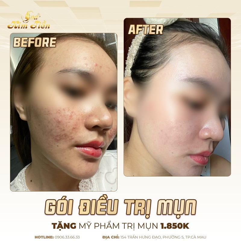 Spa Kim Tiền 2 cung cấp dịch vụ trị mụn chất lượng với mức giá phải chăng