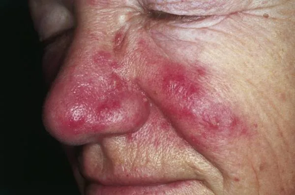 acne pustule popped ruptured pimple pus drainage infected acne