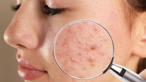 Uống kẽm trị mụn bao lâu có hiệu quả? Hướng dẫn