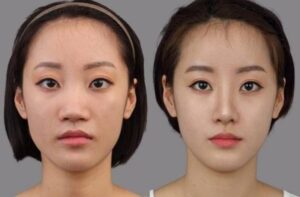 Địa chỉ nâng mũi S-line uy tín: Tiêu chí chọn cơ sở