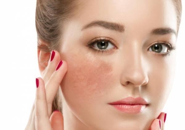 Trị nám laser pico tại các bệnh viện và phòng khám