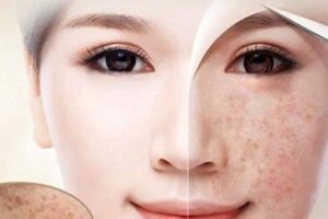 Trị nám chân sâu bằng laser pico: Quy trình và địa chỉ uy tín