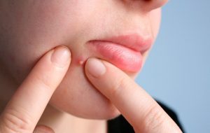 Không dùng tay trực tiếp nặn mụn mọc quanh miệng và cằm vì có thể khiến mụn lây lan