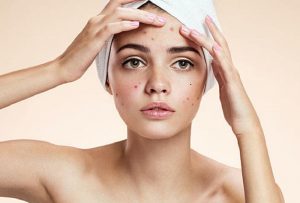 Môi trường, khói bụi, vi khuẩn, mỹ phẩm đều có thể gây ra mụn