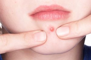 Có nên nặn mụn nhọt hay không?