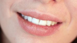                      Mụn trắng xuất hiện môi là biểu hiện của bệnh Fordyce