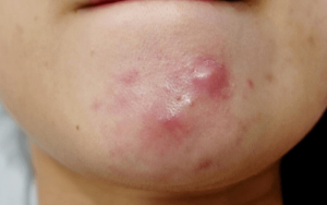 Mụn dạng cục gây đau nhức trên khuôn mặt