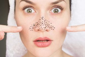 Mụn đầu đen thường gặp