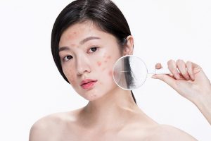 Mụn bọc bị chai là gì?