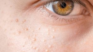 Đốt mụn gạo là phương pháp được nhiều bạn tin chọn