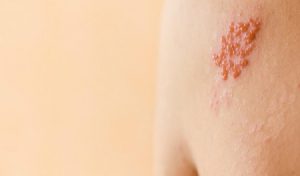 Mụn nước là một trạng thái bệnh lý về da trên cơ thể rất dễ xảy ra