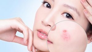 Da mụn cần chọn một loại phấn nước có uy tín, chất lượng cao để đảm bảo an toàn