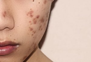 Mụn thâm là vấn đề được nhiều sự quan tâm của chị em