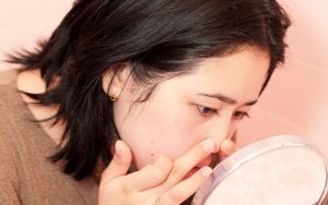 Nên nặn mụn ở các cơ sở thẩm mỹ để có được hiệu quả tốt nhất