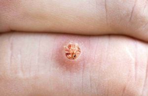 Mụn cóc hình thành do chủng Virus HPV