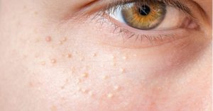 Có nhiều nguyên nhân dẫn đến mụn thịt quanh mắt