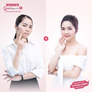 Hiệu quả trước và sau khi lựa chọn dịch vụ trị mụn của SeoulSpa.Vn