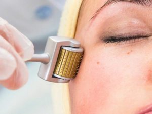 Lăn kim trị mụn có được rửa mặt không?