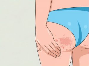 Chế độ ăn uống không hợp lý dễ gây mụn mông