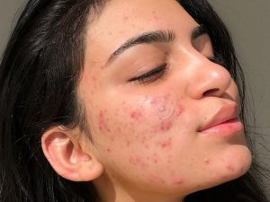 Mụn tuổi dậy thì có thể giảm dần