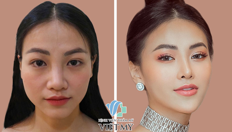 Độn cằm là một trong những dịch vụ làm đẹp nổi tiếng tại bệnh viện Việt Mỹ