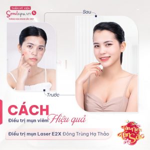 Thẩm mỹ viện SeoulSpa.Vn trị mụn hiệu quả với công nghệ Laser 2X