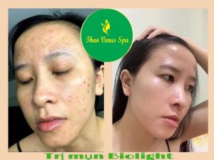 Thẩm Mỹ Viện Thảo Venus Spa trị mụn bằng phương pháp hiện đại