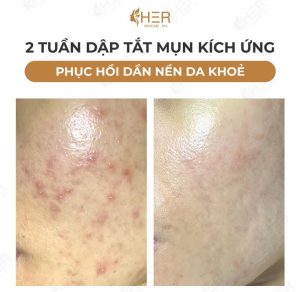 Mụn được loại bỏ nhanh chóng sau khi thực hiện điều trị tại HER Skincare & Spa