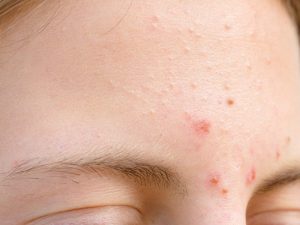 Trị mụn ở giữa 2 lông mày, giảm thâm sẹo