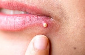 Những cách trị mụn ở mép môi nhanh chóng