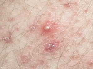 Mụn nhọt ở mép vùng kín do viêm nang lông