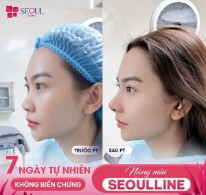 Ảnh kết quả nâng mũi của khách hàng tại Seoul Center