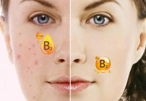 Tìm hiểu liệu vitamin B2 trị mụn có thật sự hiệu quả