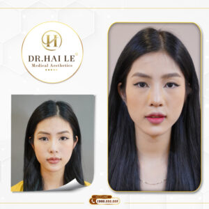 Dr. Hải Lê giúp bạn có bờ môi căng mọng quyến rũ chỉ sau 1 lần phun