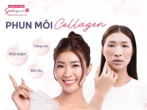 Sở hữu đôi môi căng mọng gợi cảm cùng SeoulSpa.Vn